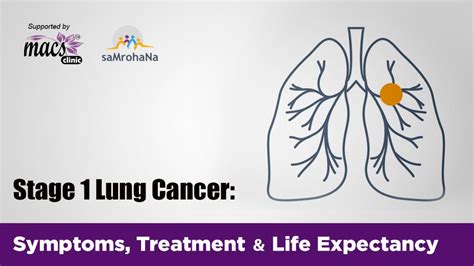 Stage 1 Lung Cancer Symptoms Treatment And Life Expectancy Macs Clinic