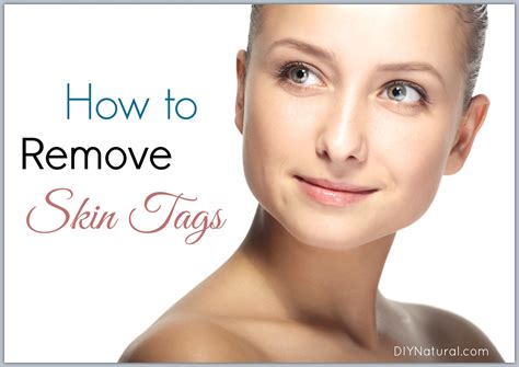 How To Remove Skin Tags 5 Ways To Get Rid Of Them Naturally