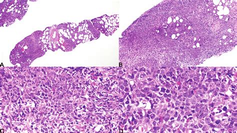 Histologic Findings In Myeloid Sarcoma Core Biopsy Specimen Of Omental