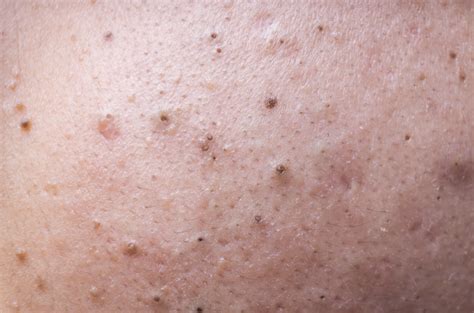 Types Of Pimples And How To Treat Them