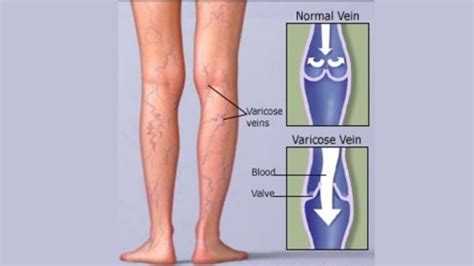 Varicose Veins Causes Symptoms Treatment Medintu