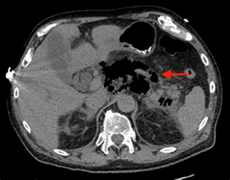 Abdominal Computed Tomography Showing Significant Pancreatic And