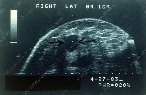 Ultrasound Image Of Benign Cyst On Female Breast Stock Image M122