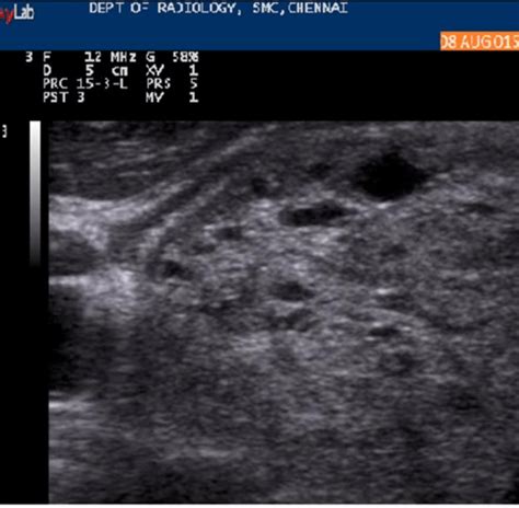 Figure Showing Diffusely Enlarged Left Lobe Of Thyroid With Multiple