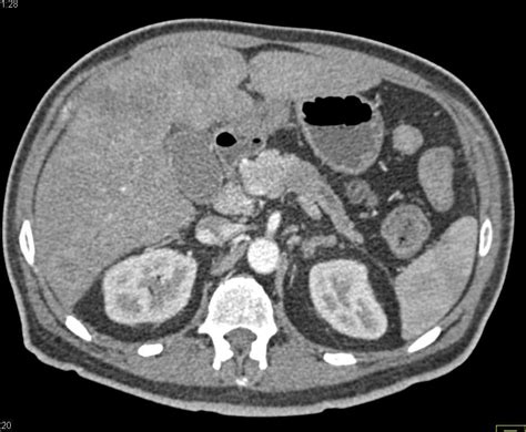 Pancreatic Cancer With Liver And Bone Metastases Pancreas Case