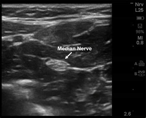 Peripheral Nerve Blocks Of The Distal Upper Extremity