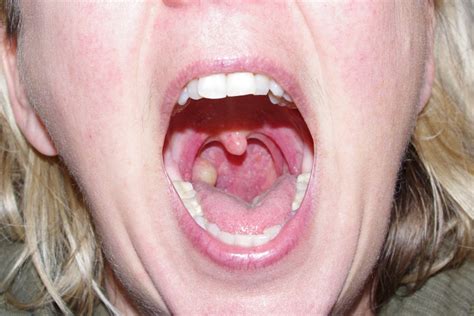 Mouth ulcers that are painful and do not heal within several the nhs recommends you drink no more than 14 units of alcohol a week. tonsil cyst 3 - Nanny Goats in Panties - Nanny Goats in ...