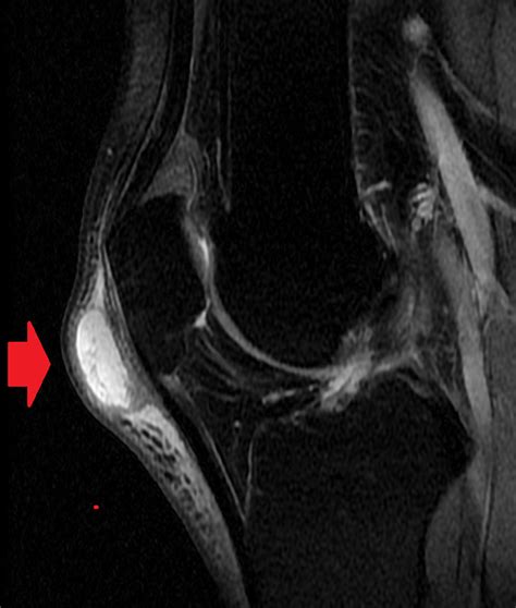 Bursitis Of The Knee Orthopaedia Sports Medicine 15552 Hot Sex Picture