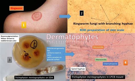 Dermatophytes Introduction Infection And Its Laboratory Diagnosis
