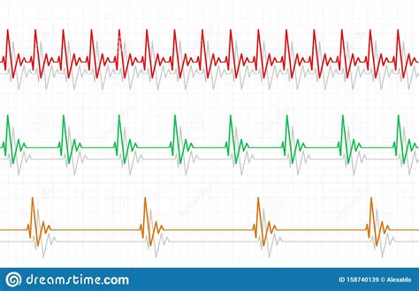Maybe you would like to learn more about one of these? Slow Heart Beats On Ecg Stock Photo | CartoonDealer.com #159436344