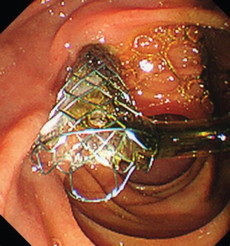 Endoscopic Sphincterotomy Before Fully Covered Metal Stent Placement Is