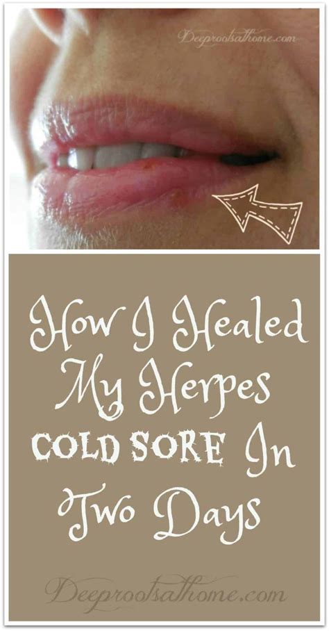 How To Cover Up A Cold Sore Scab On Your Lip Janett Woodson