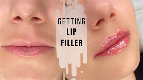 Getting Lip Filler Russian Lips Tenting Technique Healing Process