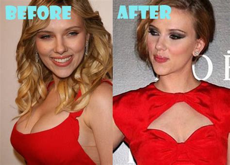 Scarlett Johansson Plastic Surgery Before And After Boob Job Lovely