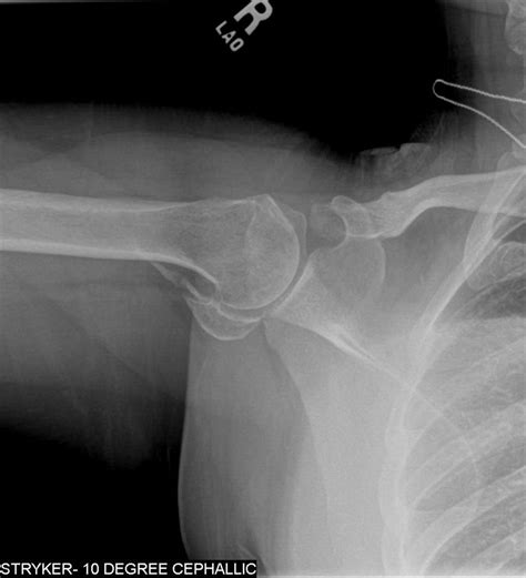 Proximal Humerus Fracture Orthobullets