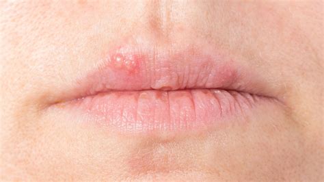 Lippenherpes ist die häufigste erscheinungsform von herpes. Lippenherpes richtig behandeln | NDR.de - Ratgeber ...