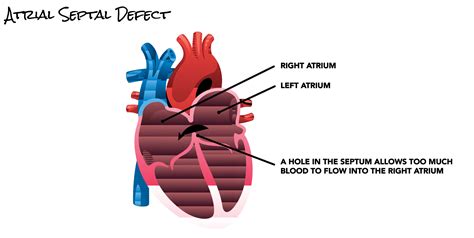 Septum Heart