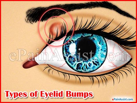 An eyelid bump can be a pimple, an inflamed oil gland or even a sty. Types of Eyelid Bumps & Treatment to Get Rid of it