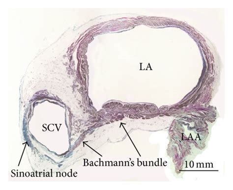 A Dissection To Show Bachmanns Bundle Crossing The Anterior