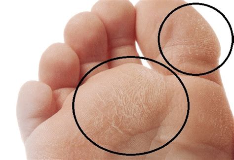 Diabetic Foot Infection Symptoms Causes And Treatment