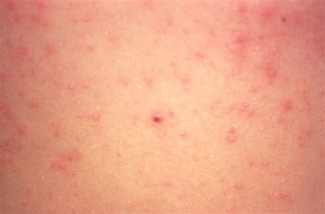 Scabies Causes Symptoms And Treatment Live Science