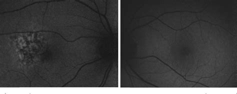 Figure 1 From Acute Retinal Pigment Epitheliitis Spectral Domain