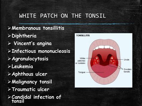 White Patch On The Tonsil Differential Diagnosis