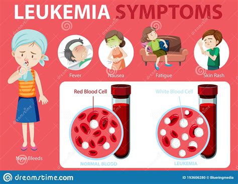 Leukemia Symptoms Cartoon Style Infographic Stock Vector Illustration