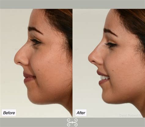 Non Surgical Nose Job Charleston Nose Reshaping Without Surgery Dr