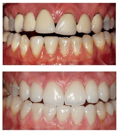 Periodontal Treatment Gum Disease Windsor