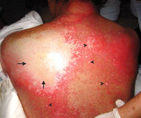 Second degree burns normally heal without any scarification when treated with good care. Gastric acid burns because of a disconnected nasogastric ...