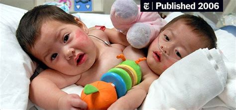 Conjoined Twins Separated By Surgeons The New York Times