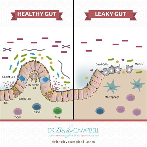 The Leaky Gut Autoimmune Disease Connection Dr Becky Campbell Leaky