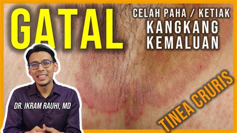 Ubat Gatal Celah Kelangkang Farmasi Ubat Gatal Kemaluan Di Farmasi