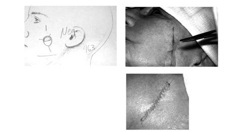 The Principles Of Mohs Micrographic Surgery For Cutaneous Neoplasia