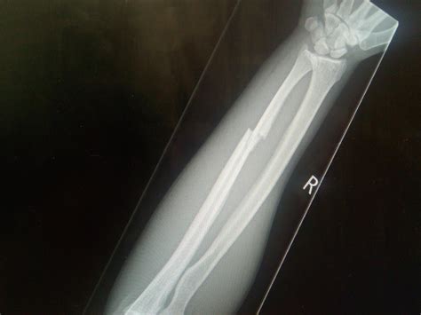 Fractured Forearm Ulna Healing Process Possible Non Union