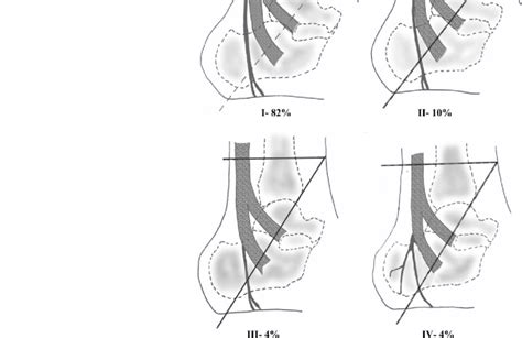 Patterns Of Origin Of The Inferior Calcaneal Nerve Are Shown The