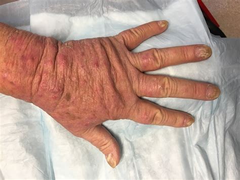 Dermdx Thin Erythematous Plaques On Upper Arms And Hands Dermatology