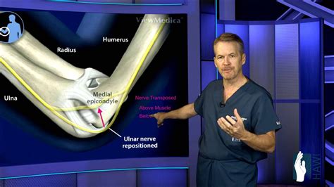 Cubital Tunnel Surgery Carpal Tunnel Surgery Cubital Tunnel Cubital