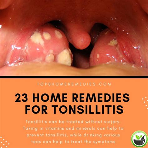 Tonsillitis Treatment