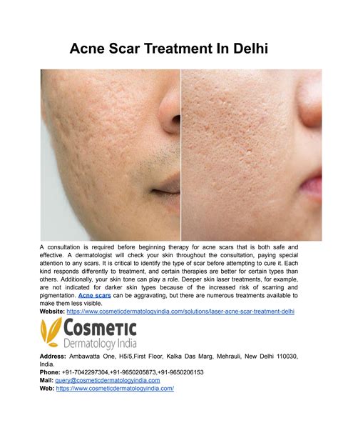 Acne Scar Treatment In Delhi By Cosmeticdermatologyindia01 Issuu