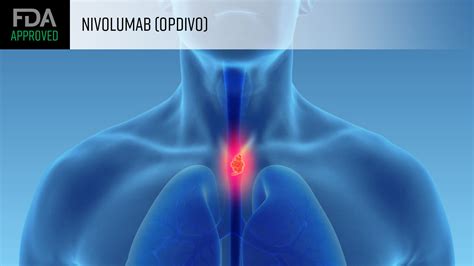Adjuvant Opdivo OK D For Esophageal GEJ Cancers MedPage Today
