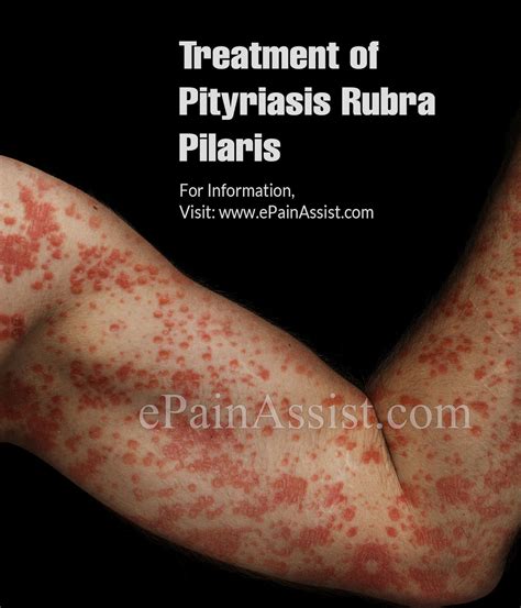 What Is Pityriasis Rubra Pilaristypescausessymptomstreatmentprevention