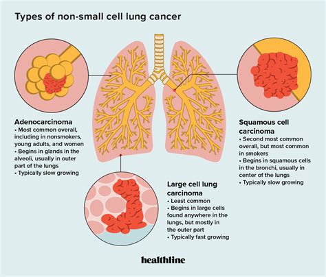 types of non small cell lung cancer causes treatment and outlook