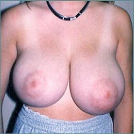 Erotic Abnormal Breasts Xxx Album