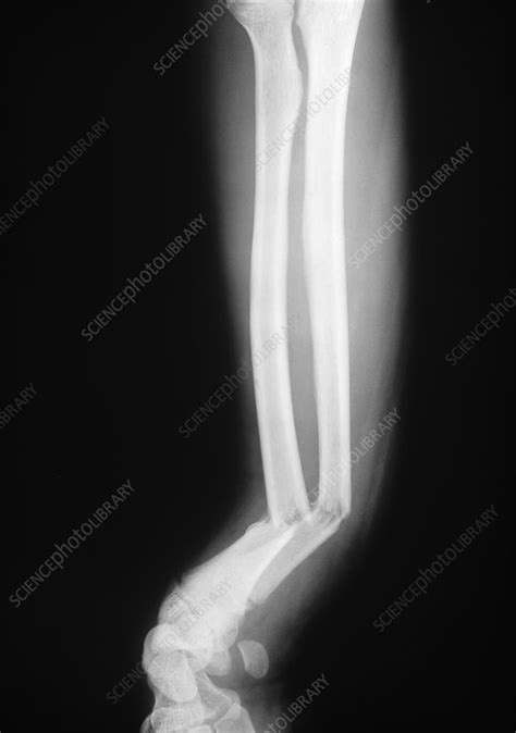 Broken Arm X Ray Stock Image C0036353 Science Photo Library
