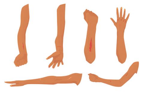 Hematoma Arm Illustrations Royalty Free Vector Graphics And Clip Art