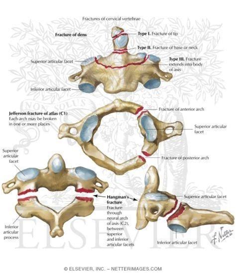Cervical Spine Fracture Types Cervical Fractures The Nurse Cares For