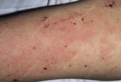 Eczema On An Arm Stock Image M150 0234 Science Photo Library