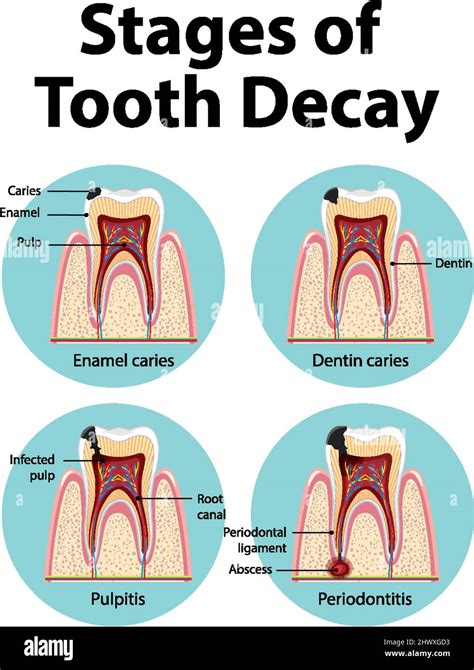 Infographic Of Human In The Stages Of Tooth Decay Illustration Stock